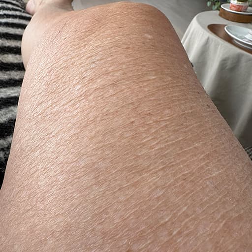 Before The Solution Collagen Jette